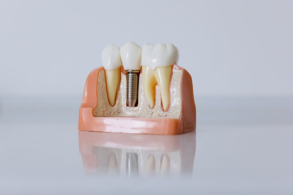 Cross-section dental model showing a titanium implant post between natural teeth.