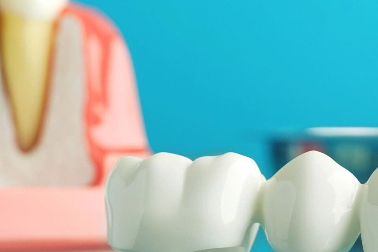 Ceramic dental bridge on a blue-background model showing crown fitting