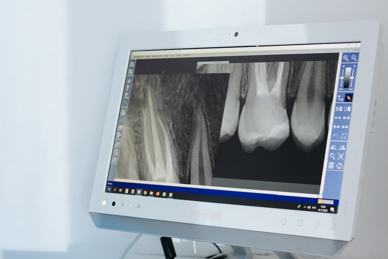 Dental X-ray of tooth roots displayed on a clinic monitor